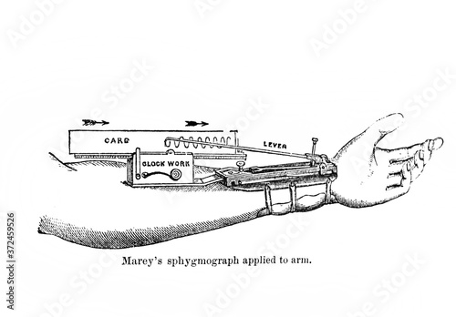 Marey's sphygmograph applied to arm in the old book Human phisiology by H. Chapman, Philadelphia, 1887