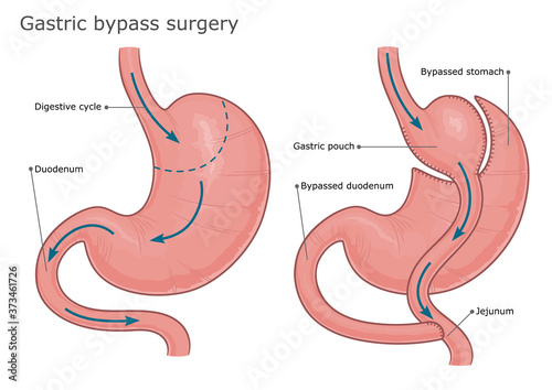 Gastric bypass surgery before and after. Vector illustration. 