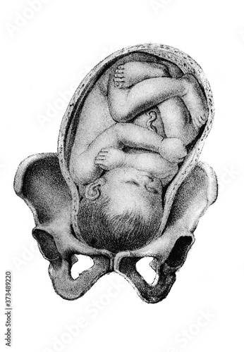 Small baby inside the woman's womb in the old book Atlas Abildungen by D. W. Busch, Berlin, 1841