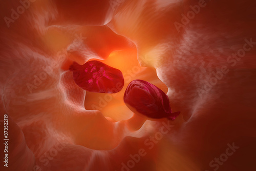 3D Illustration of a gastrointestinal polyp during Entersocopy