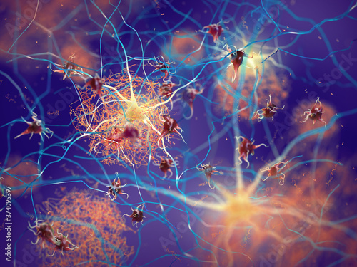 Amyloid plaques forming between neurons. Beta-amyloid protein disrupting nerve cells function in a brain with Alzheimer's disease