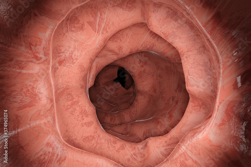 3D Illustration of a gastrointestinal polyp during Entersocopy