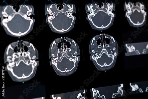 Brain CT scan x-ray film image Brain