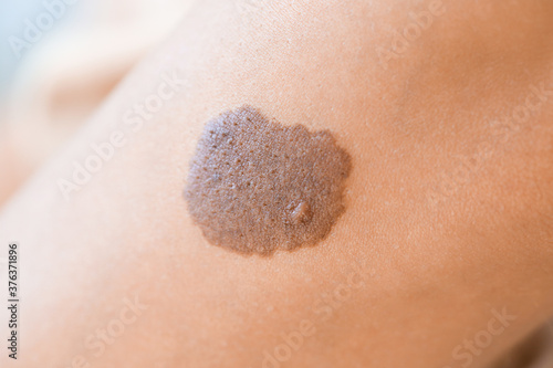 Birthmark on human skin, closeup