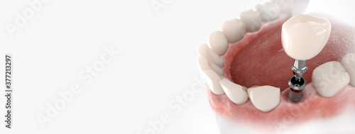 Dental crown, abutment and implant. 3D illustration of human teeth and dentures on white background.