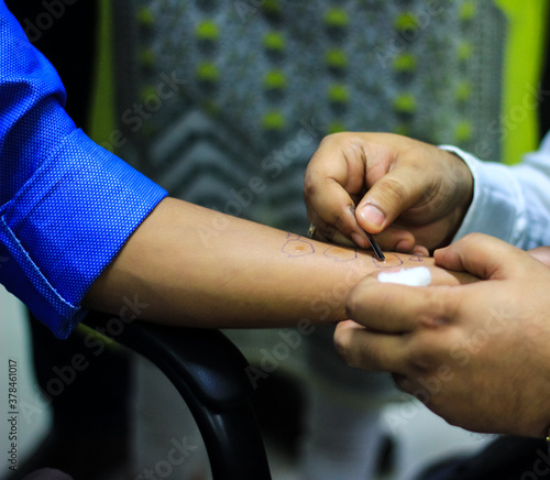 skin allergy test preparation by doctor on a patient hand using lancet to prick the skin