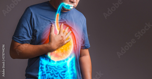 gastroesophageal reflux disease (GERD)., x-ray concept.