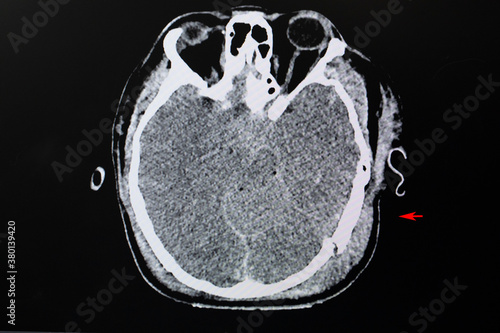 CT scan of skull fracture and cerebral hemorrhage