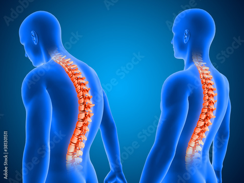 3D medical background showing correct and poor posture with spine highlighted