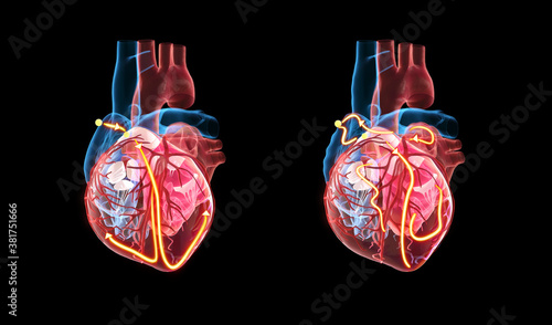 Anatomy of the human heart, the yellow lines demonstrating the electrical (conduction) system of the heart. On the righten side an irregular heartbeat / arrythmia / atrial fibrillation is shown.