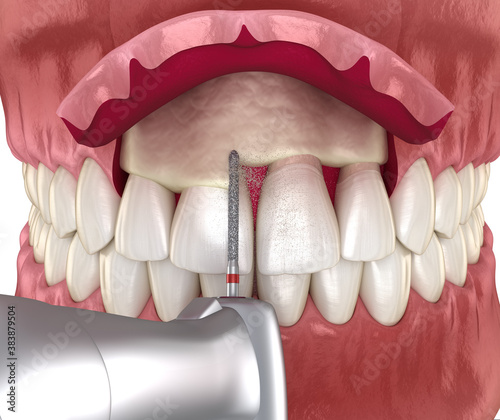 Frontal crown lengthening, Esthetic surgery. Medically accurate dental 3D illustration