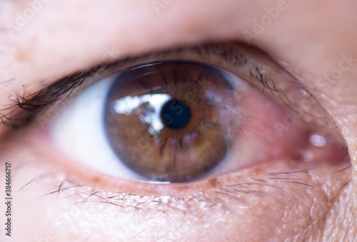 The eyes of people with cataract, a disease of the eye.
