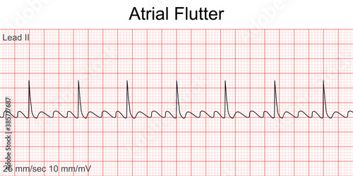 Electrocardiogram show Atrial flutter pattern. Cardiac fibrillation. Heart beat. CPR. ECG. EKG. Vital sign. Life support. Defib. Emergency. Medical healthcare symbol.