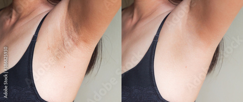 Image before and after skincare cosmetology armpits epilation treatment concept.Problem underarm chicken skin,Fox Fordyce,black armpit in woman.