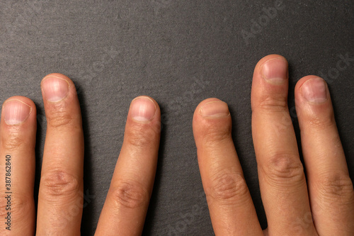 index finger after hand surgery. Damaged finger. after gangrene