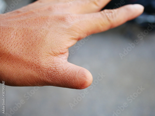 closeup of hand with amputated finger.