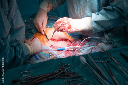 gynecologist sews a stomach back together after a caesarean section