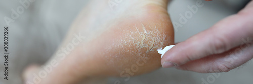 Close-up of person applying smoothing cream on damaged and problem areas on skin. Barefoot man with unhealthy and unattractive heel. Effect of uncomfortable shoes