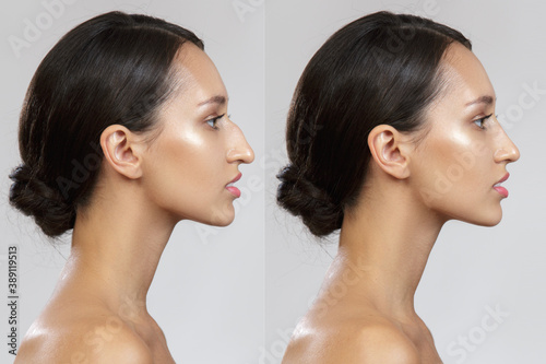 Comparison of the female nose after plastic surgery. Before after. Rhinoplasty