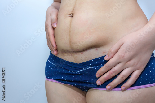 Scar on a woman's stomach after pregnancy and cesarean section