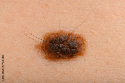 large nevus on the skin very close-up. A concept for preventing melanoma or removing moles and formations on the skin.