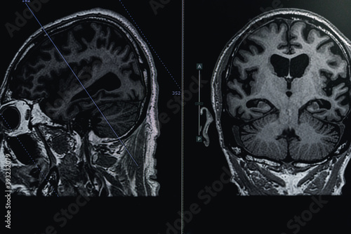 MRI of brain Dementia protocol with Alzheimer's disease Take a picture from the computer 