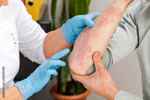 A dermatologist wearing gloves examines the skin of a sick patient. Examination and diagnosis of skin diseases-allergies, psoriasis, eczema, dermatitis