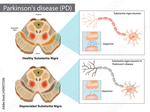 Parkinson s disease PD . Normal and Depreciated Substantia Nigra