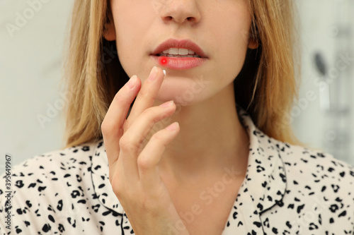 Woman with herpes applying cream onto lip on blurred background, closeup