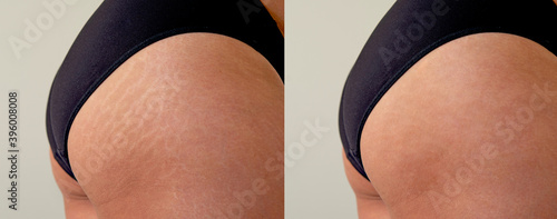 Image compare before and after Woman buttocks with stretch marks removal treatment, real people