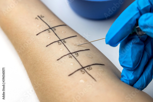 allergist doing skin prick allergy test on a patient arm closeup