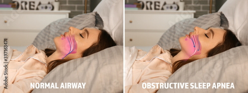 Illustrations showing difference between normal breathing and obstructive sleep apnea