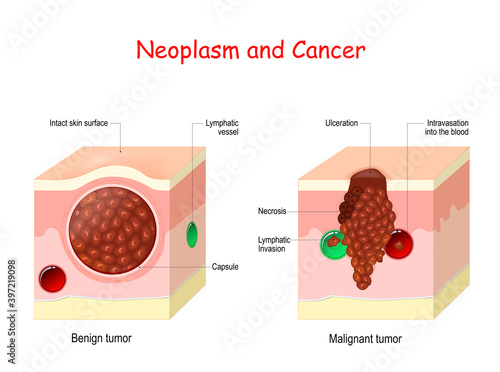 Cancer and Neoplasm. comparison and difference between Malignant and Benign tumor