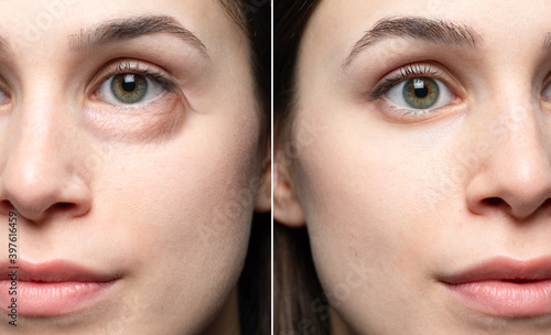 the effects of cosmeceutical against skin aging: before and after treatment