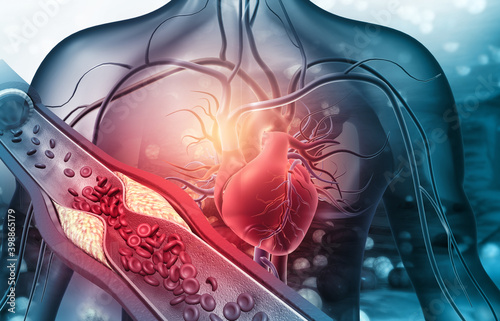 Human heart with blocked arteries. 3d illustration.