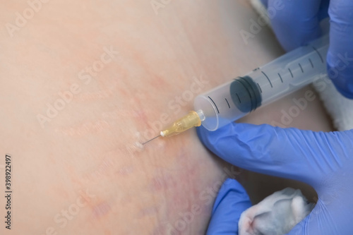 Doctor makes injection of ozone gas in patient woman on side of body on ozone therapy, closeup view. Treatment, cure and remove of skin tags and stretches. Correction of skin after pregnancy.