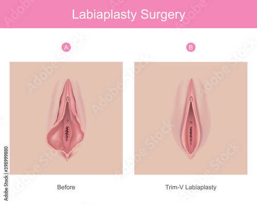 labiaplasty surgery. Illustration for medical use explain a procedure surgery to decrease the size of inner tissues the female genitalia..
