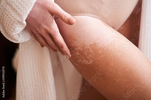 Woman with vitiligo dermatology disease applying legs cream
