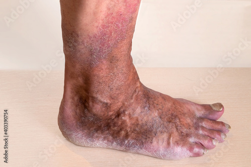 Varicose veins are bulging