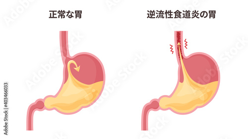 逆流性食道炎の胃と胃酸のイラスト