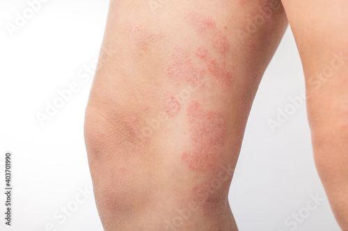 Severe atopic eczema on the legs of a child is a dermatological disease of the skin. Large, red, inflamed, scaly rash on the legs. Legs of a teenager with severe atopic dermatitis.Close-up