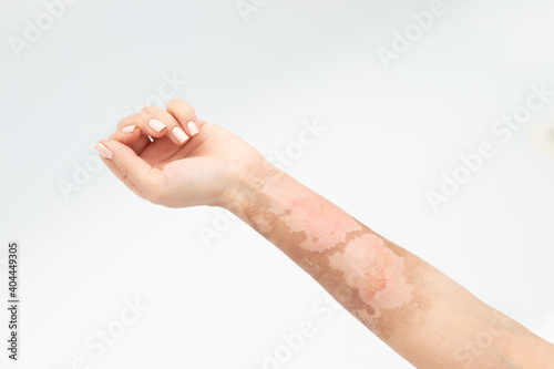 Thermal burn on the hand, skin peeling