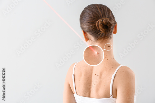 Young woman undergoing procedure of nevus removal by laser on light background