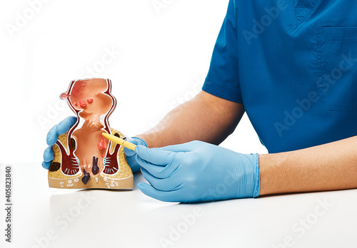 Proctologist pointing pen rectum pathologies on an anatomical model. Treatment of rectal diseases, hemorrhoid