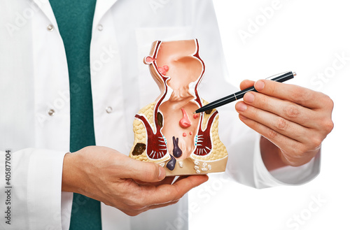 Treatment of rectal diseases, hemorrhoid. Proctologist pointing pen rectum pathologies on an anatomical model