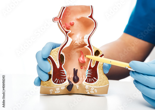 Close-up, rectum pathologies on an anatomical model. Treatment of rectal diseases, hemorrhoid