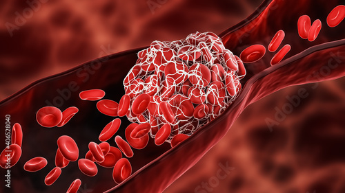 Blood Clot or thrombus blocking the red blood cells stream within an artery or a vein 3D rendering illustration. Thrombosis, cardiovascular system, medicine, biology, health, pathology concepts.