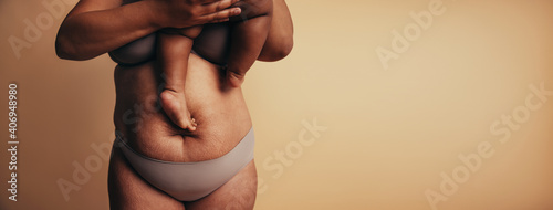 Postpartum belly with stretch marks