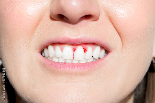 Woman mouth with bleeding gums. Periodontal disease