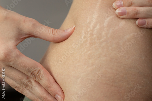 Young woman showing stretch marks on her body.